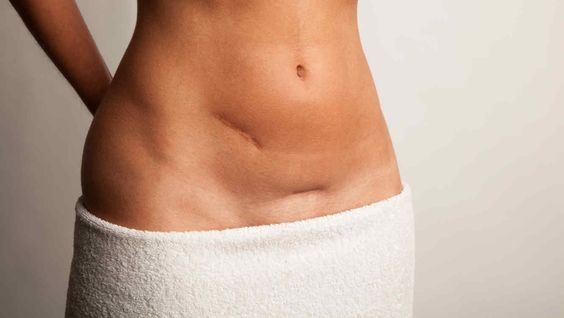 doğum izi olan kadın