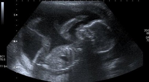 ultrasonda bebek