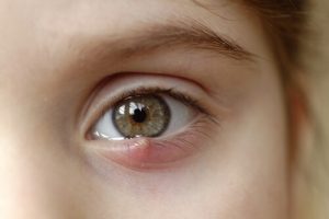 Çocuklarda Arpacık: Ne Yapmalı ve Nasıl İyileştirmeli?