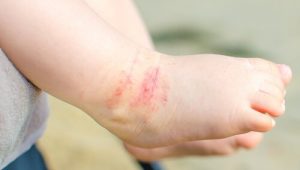 Çocuklarda Atopik Dermatit Tedavisi İçin 15 Tavsiye