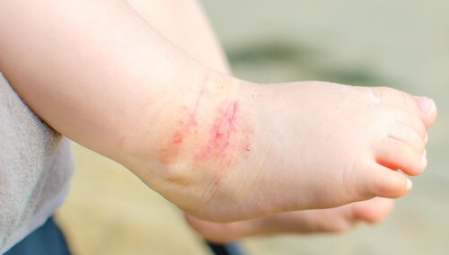 Çocuklarda Atopik Dermatit Tedavisi İçin 15 Tavsiye