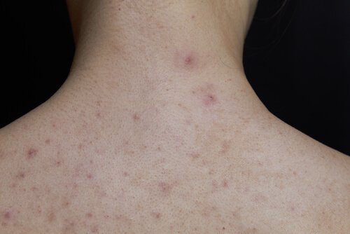 çocuklarda kızıl hastalığı