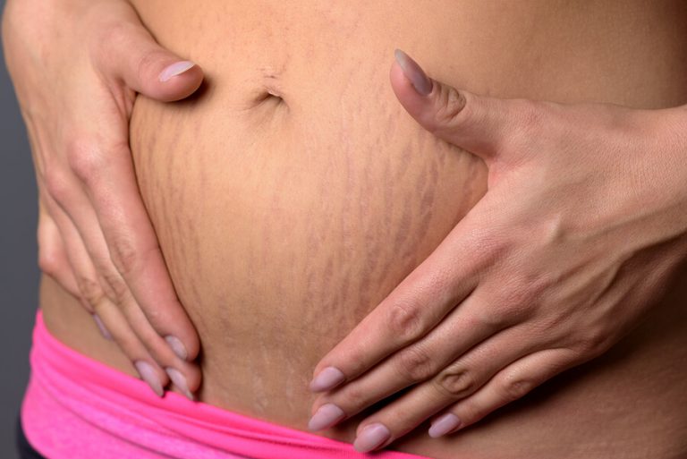 Hamilelik sırasında oluşan çatlaklardan nasıl kurtulunur?