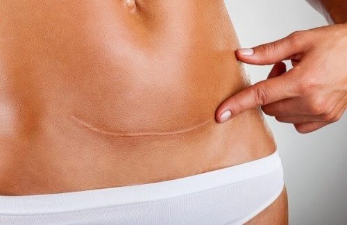 sezaryen doğum yarası