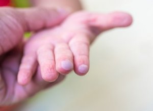 Çocuğumuzun cildi su toplarsa (vezikül) nasıl tedavi ederiz?