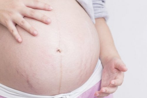Hamilelik sırasında doğum çatlakları ile nasıl başa çıkılır?