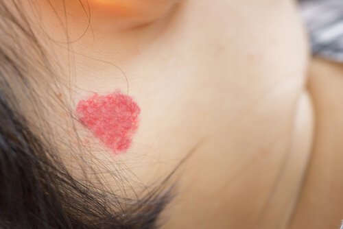 bebeğin boynunda kızarıklık