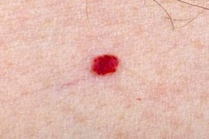 Çocuğumda Angioma Varsa Ne Yapmalıyım?