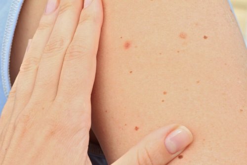 cilt üzerinde benler