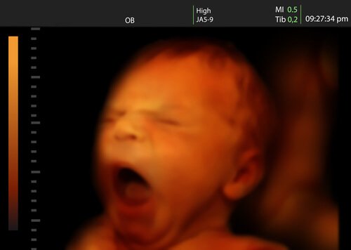 bebek ultrason görüntüsü