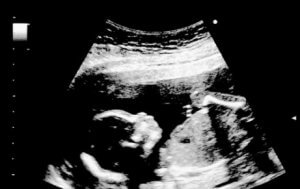 ultrasonda 18 haftalık bebek