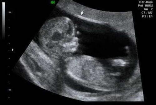ultrasound