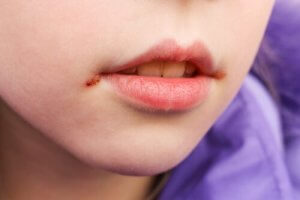 Çocuklarda Ağız Yaraları: Nedenleri ve Tedavisi