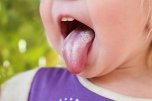 Çocuklarda Kandidiyaz: Belirtileri, Nedenleri ve Tedavisi