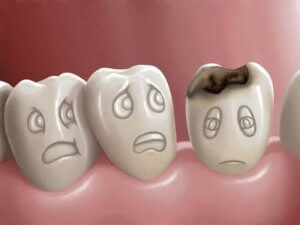 Diş Çürükleri Nedir ve Nasıl Önlenir?
