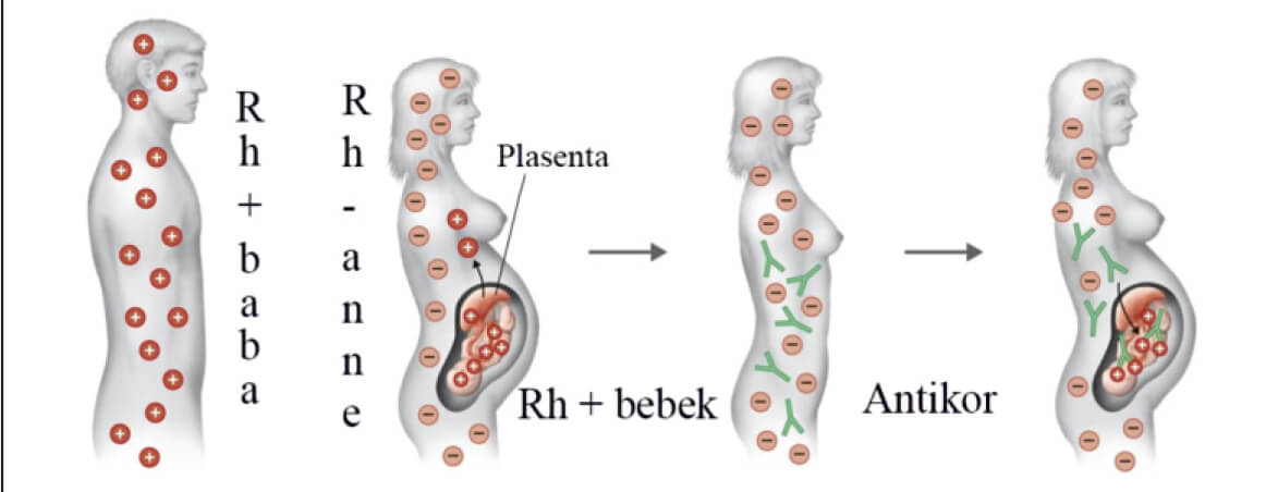 Rh uyuşmazlığı tablosu
