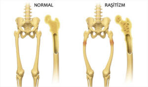 Raşitizm: Çocuklarda D Vitamini Eksikliği
