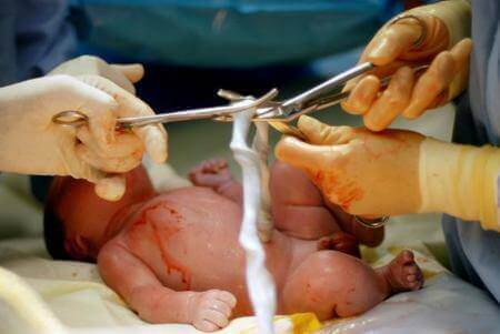 Doğum sonrası göbek bağı kesilen bebek