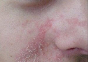 Ciltte dökülme ve kızarıklık