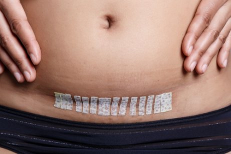 Rahim alma ameliyatı olmuş kadın