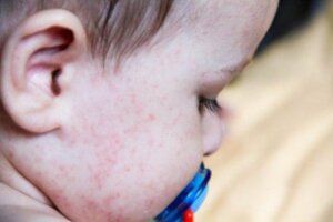 Gıda alerjileri sebebiyle cildi kızarmış çocuk
