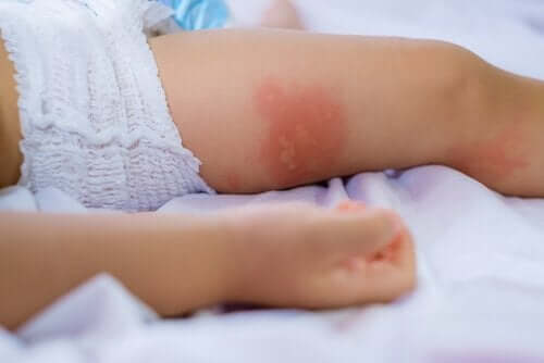 cilt alerji bebek