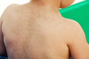 Sırtında aşırı tüylenme olan çocuk hasta