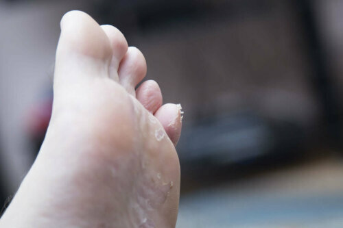 ayak tabanında soyulma