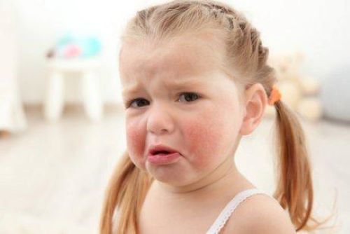 Çocuklarda lateks alerjisi ve göz nezlesi