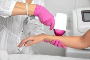 Hirsutizm sebebiyle koluna epilasyon yaptıran kadın