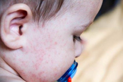 Lateks alerjisi olan emzikli bebek