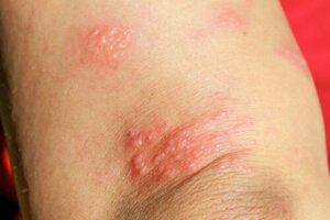 Pemfigoid Gestasyones Nedir?