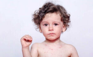 Cilt alerjisi olmuş çocuk