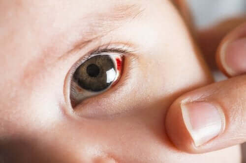 Bebeğimin Gözlerindeki Kırmızı Lekeler Nelerdir?