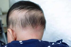 Bir bebeğin saçı orta bölgeden tamamen dökülmüş